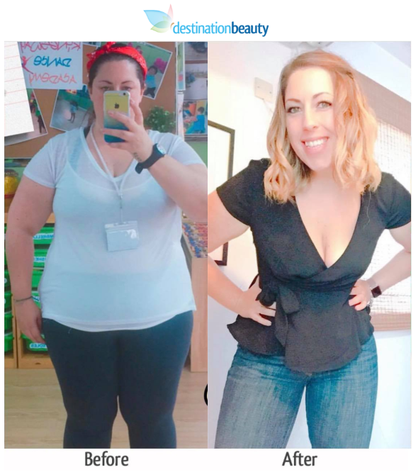 Kierian lost 35 kgs 6 months after gastric sleeve in Thailand